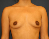 Feel Beautiful - Breast Augmentation 134 - Before Photo